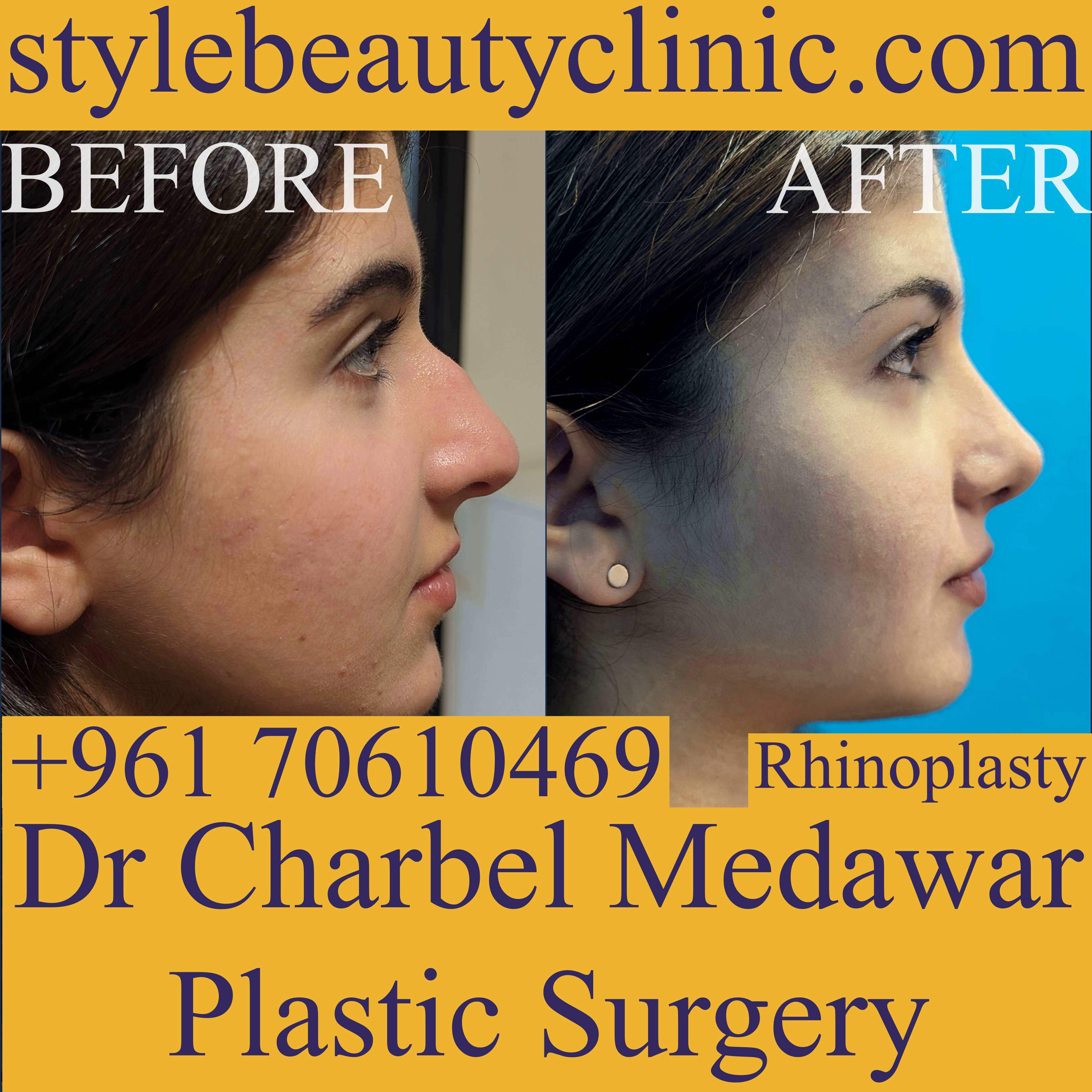 rhinoplasty lebanon dr charbel medawar