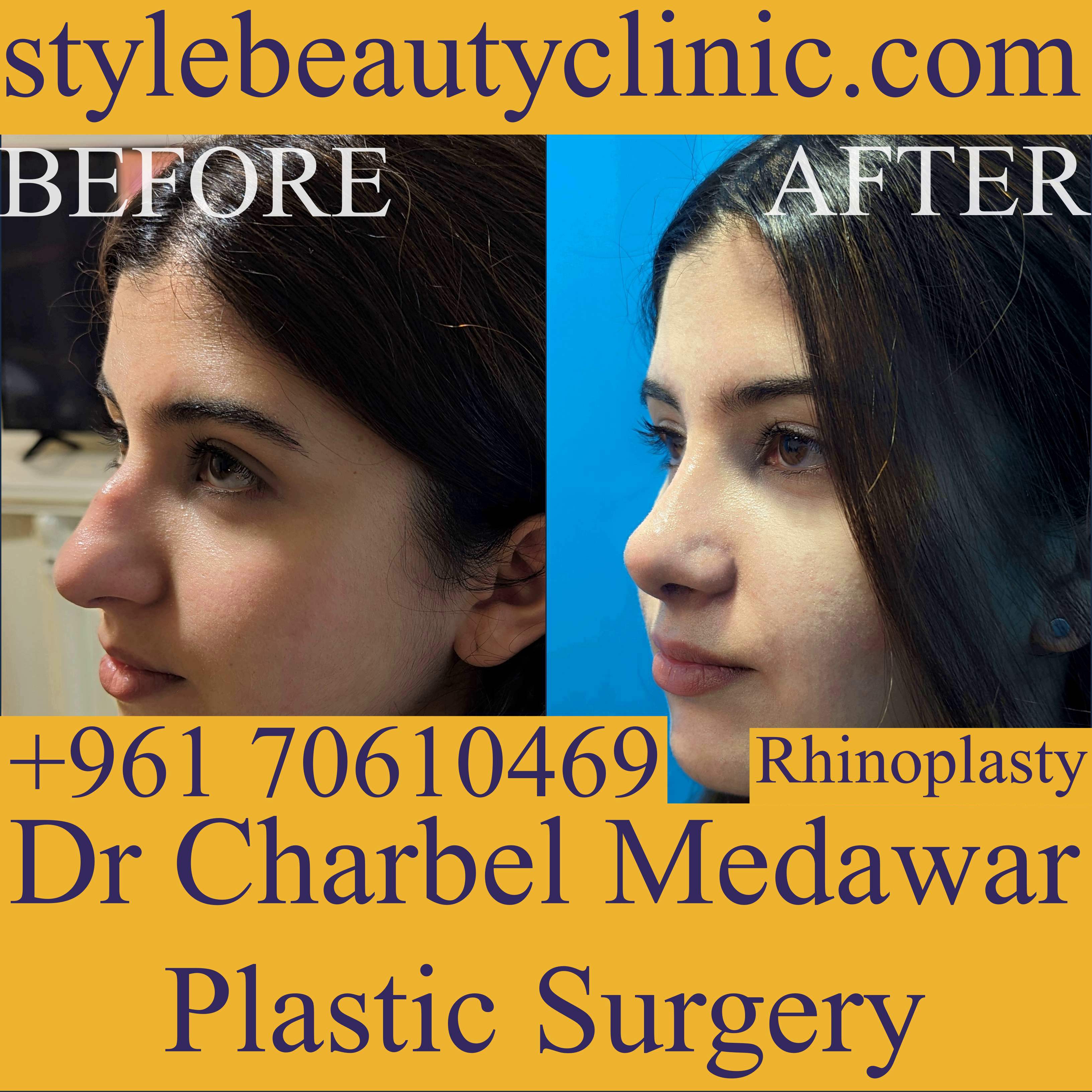 rhinoplasty price lebanon