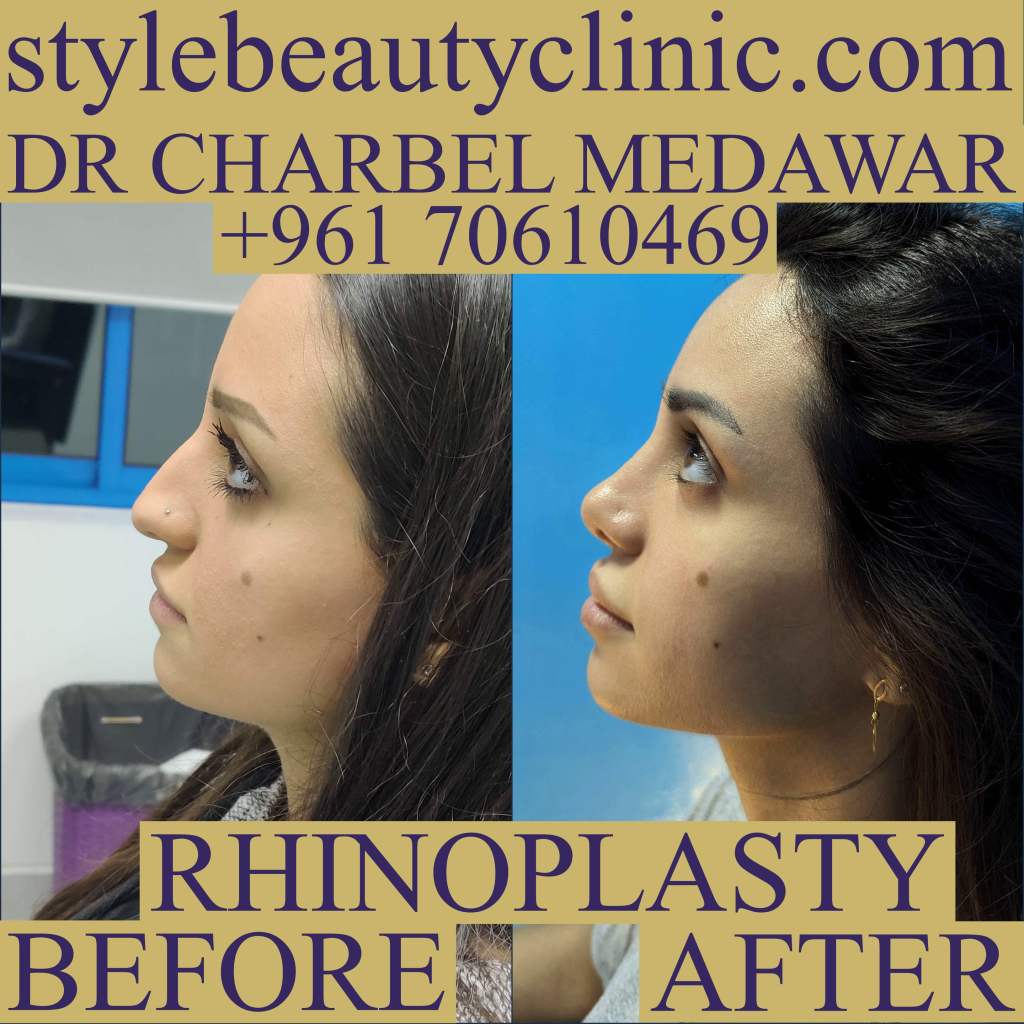 rhinoplasty top doctor in lebanon dr charbel medawar