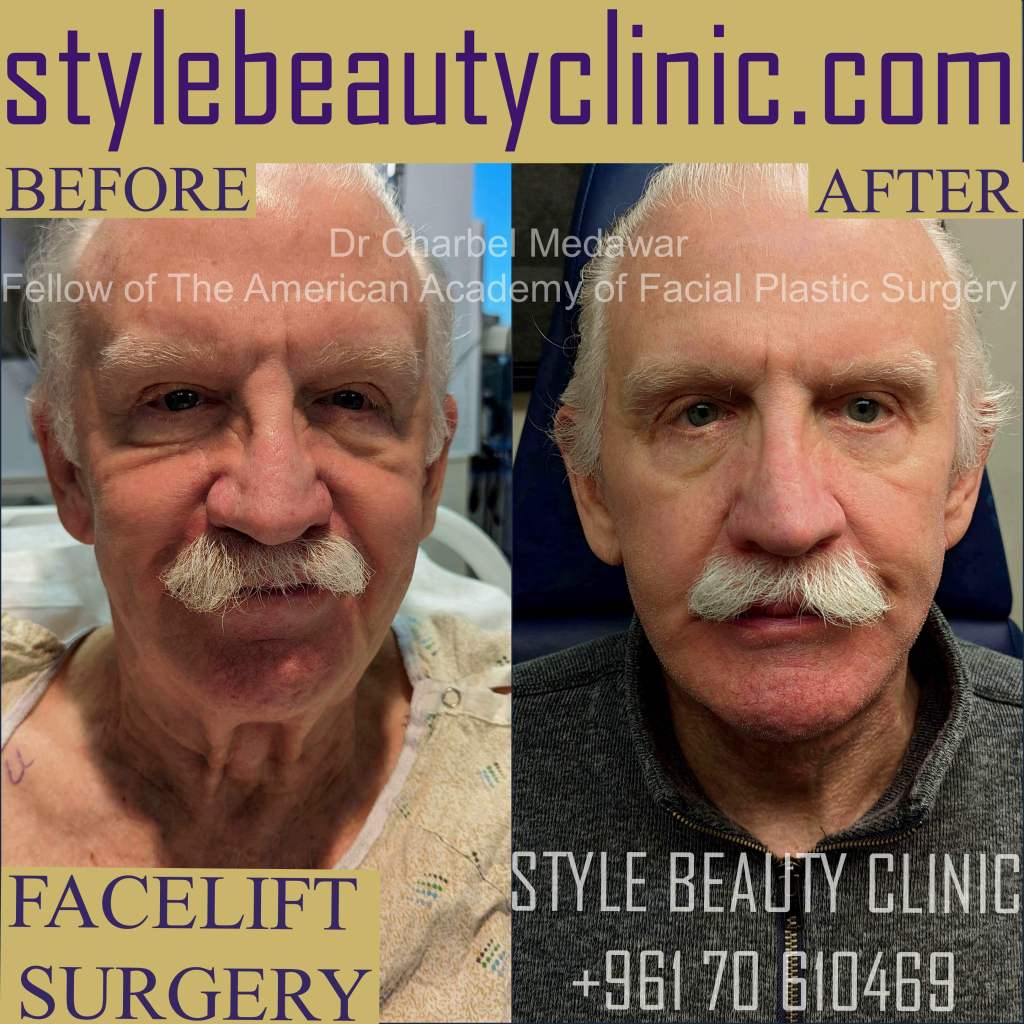 facelift dr charbel medawar Plastic Surgery Doctors In Lebanon