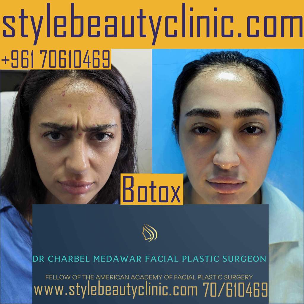 Dr. Charbel Medawar botox for hooded eyes Dr. Charbel Medawar botox for hooded eyes
