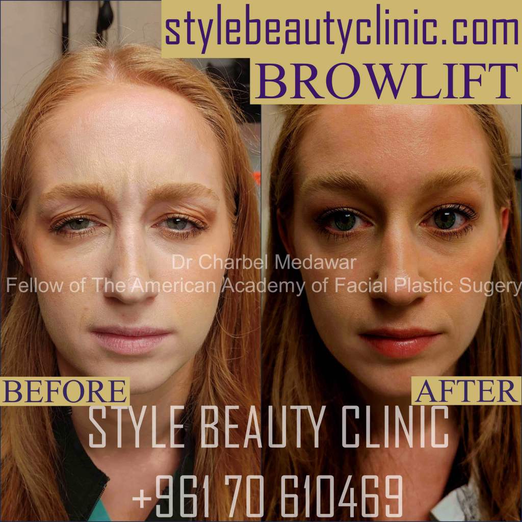 brow lift In Lebanon Prices dr charbel medawar