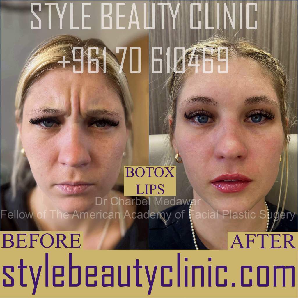 top botox doctor lebanon charbel medawar