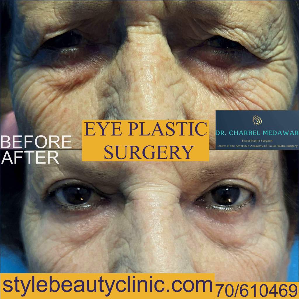 top eye plastic surgery rejuvenation lebanon dr charbel medawar