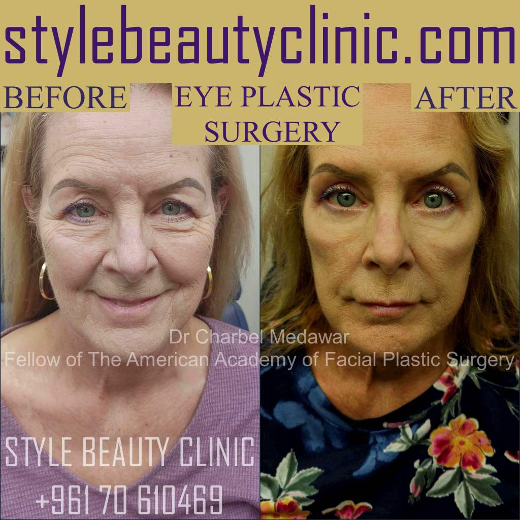 top eyelid plastic surgery lebanon dr charbel medawar