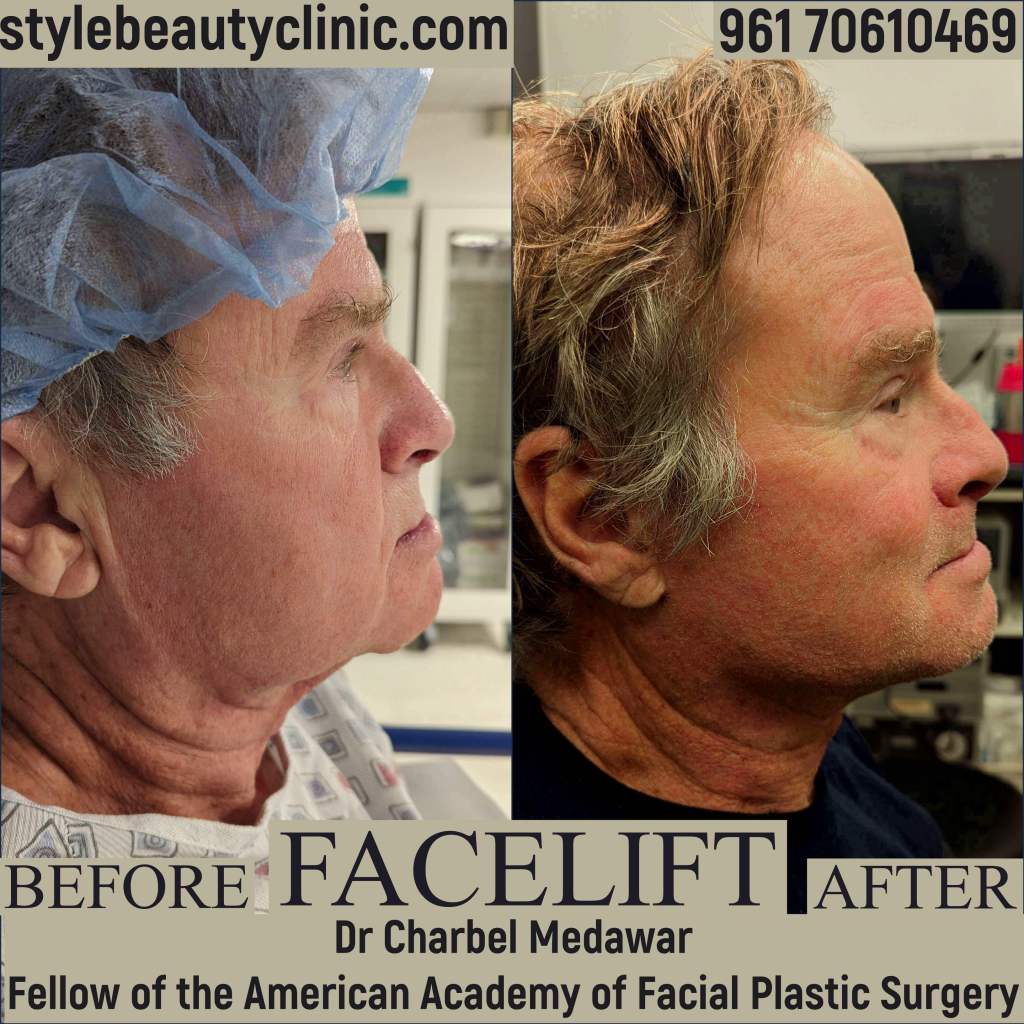 top facelift expert in lebanon dr charbel medawar