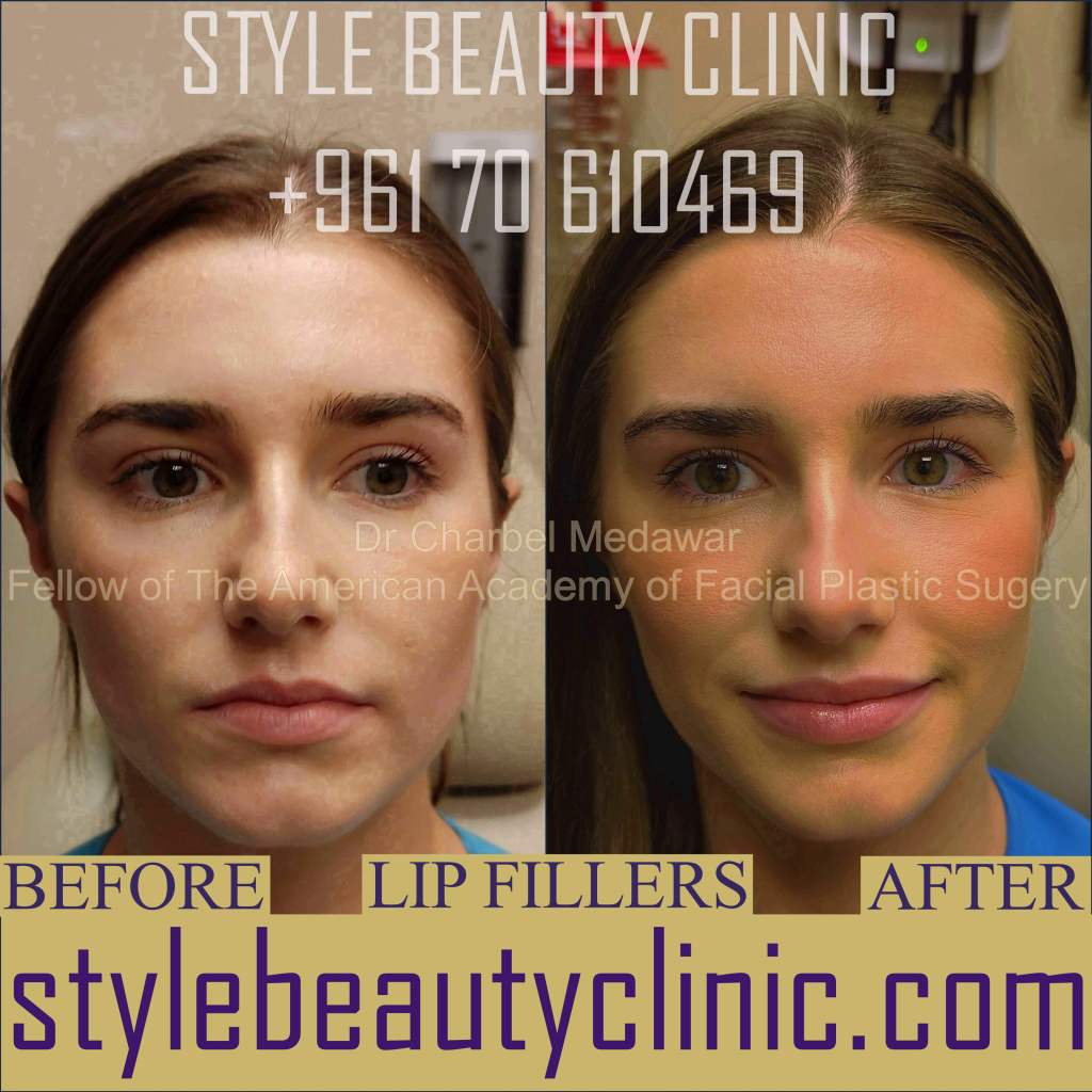 top lip fillers doctor in lebanon charbel medawar