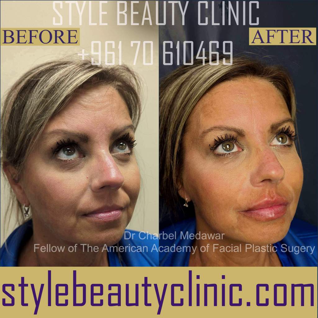 top liquid facelift doctor in lebanon charbel medawar