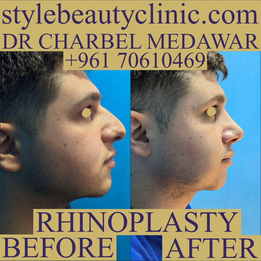 top nose plastic surgeon in lebanon dr charbel medawar
