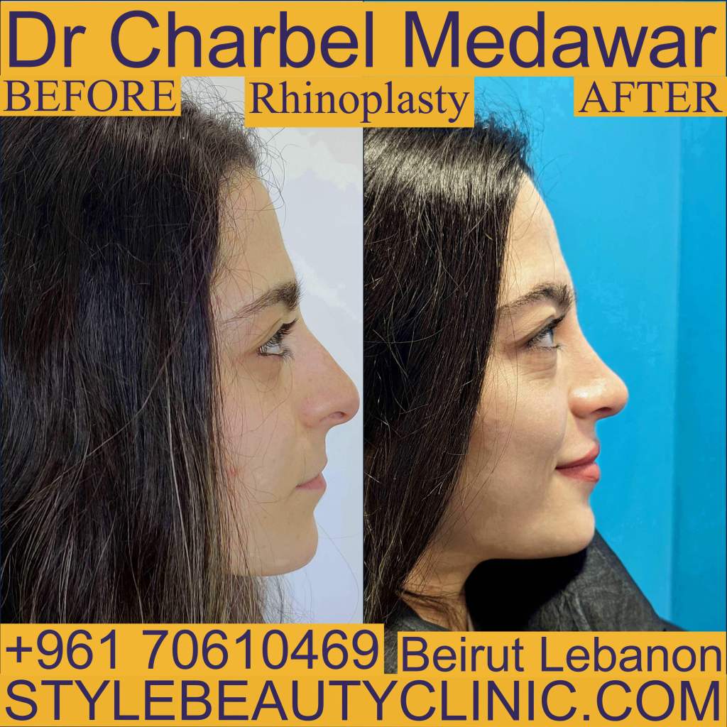 top rhinoplasty doctor in lebanon charbel medawar top rhinoplasty doctor in lebanon charbel medawar