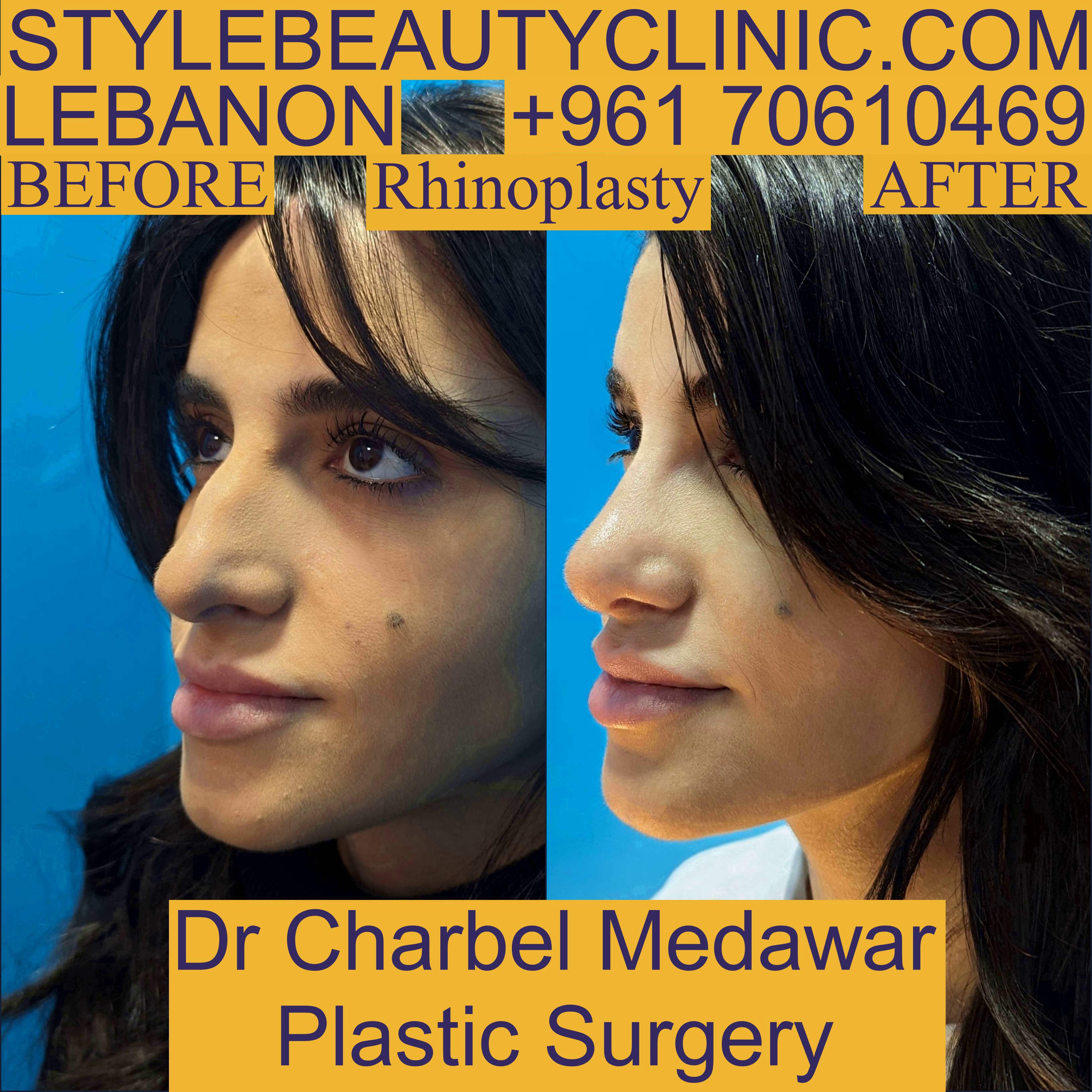 top rhinoplasty doctor lebanon charbel medawar