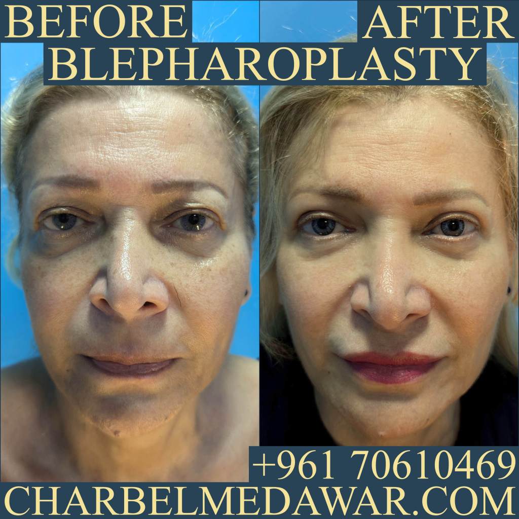 blepharoplasty charbel medawar