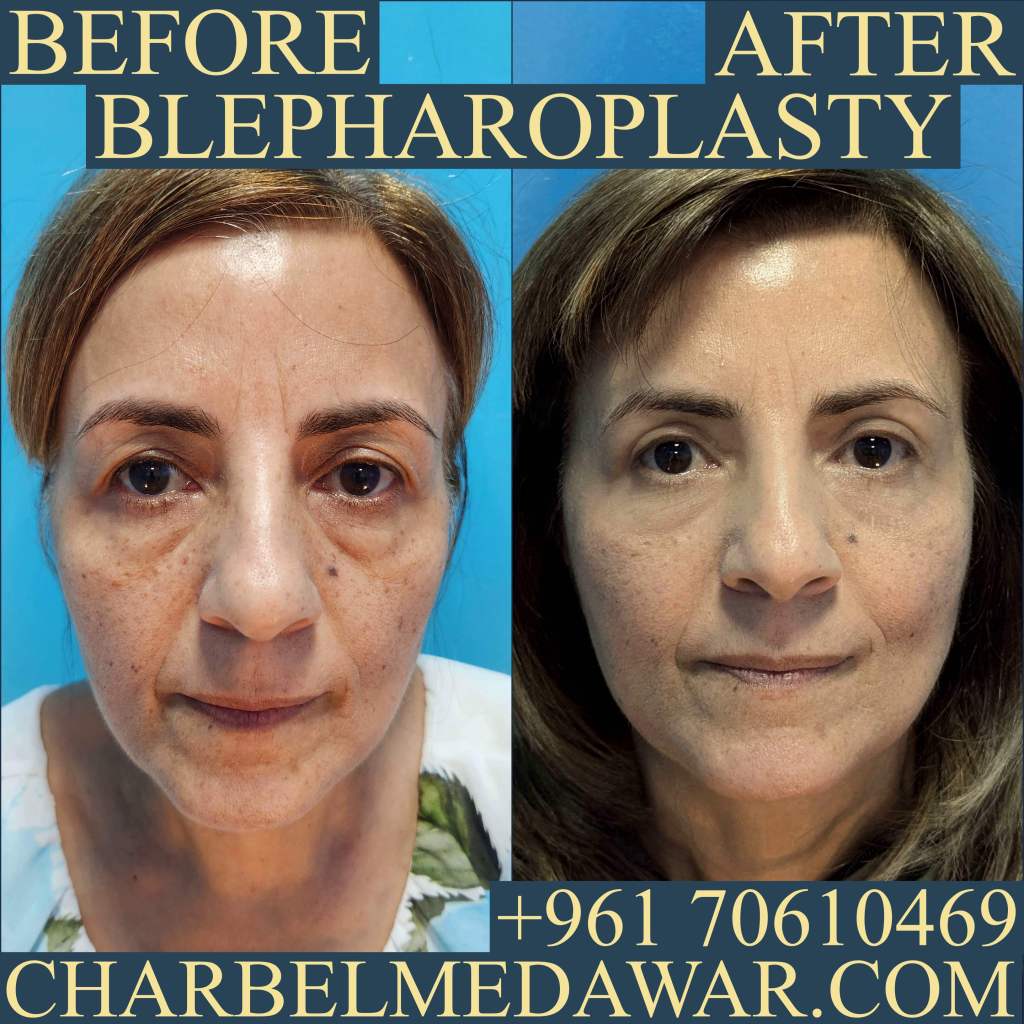 dr charbel medawar oculoplastic expert