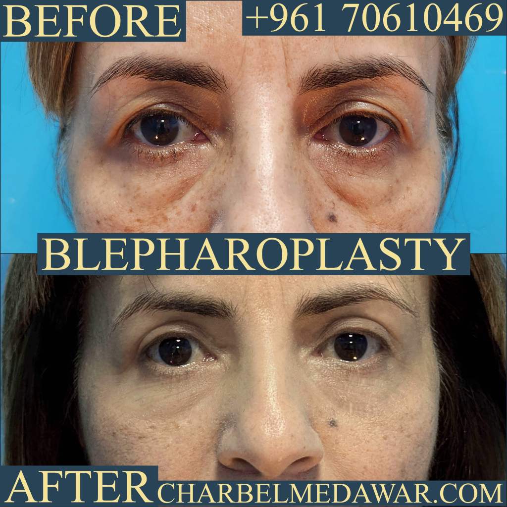 dr charbel medawar oculoplastic specialist