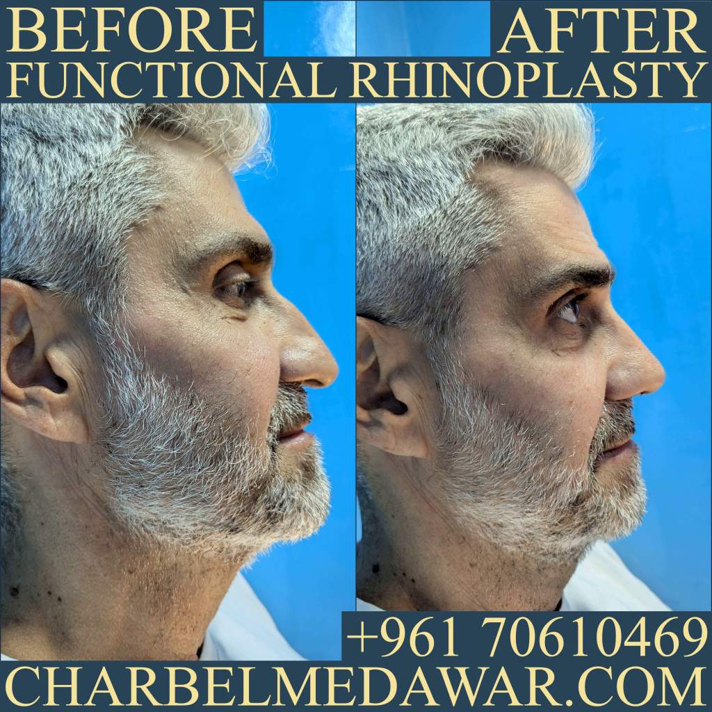 dr charbel medawar septorhinoplasty Lebanon