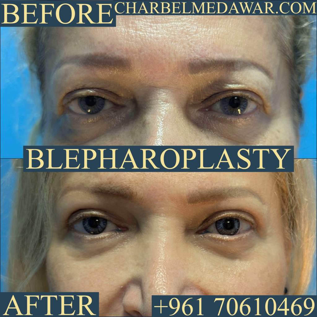 eye plastic surgery charbel medawar