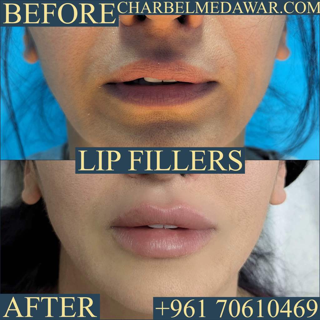 lip fillers Lebanon charbel medawar