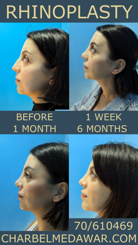 BEST nose SURGEON IN LEBANON BEFORE AND AFTER