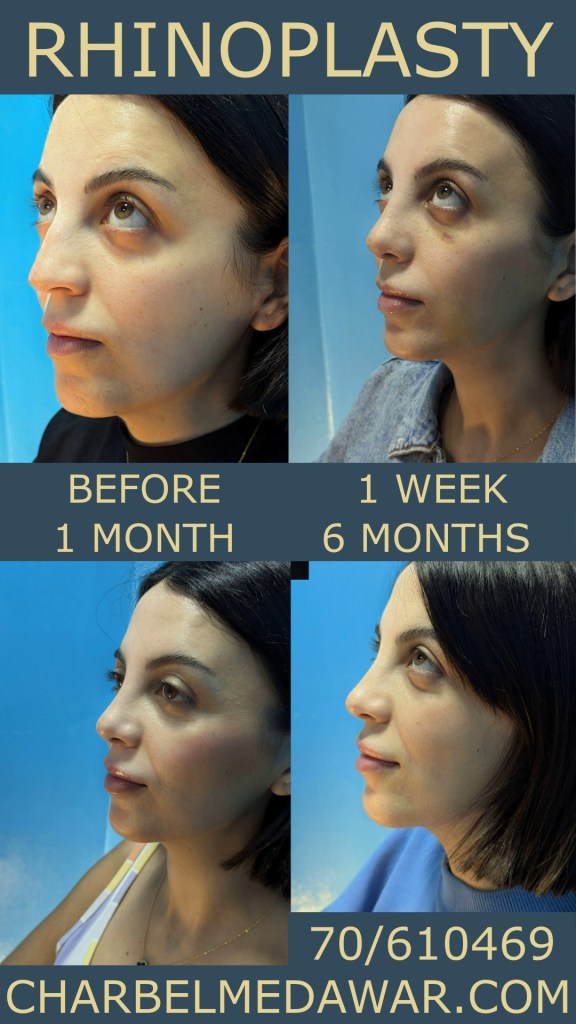 BEST RHINOPLASTY SURGEON IN LEBANON BEFORE AFTER