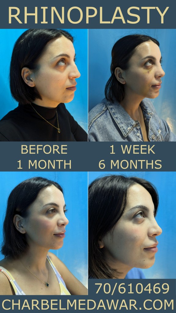 BEST RHINOPLASTY SURGEON IN LEBANON BEFORE AND AFTER