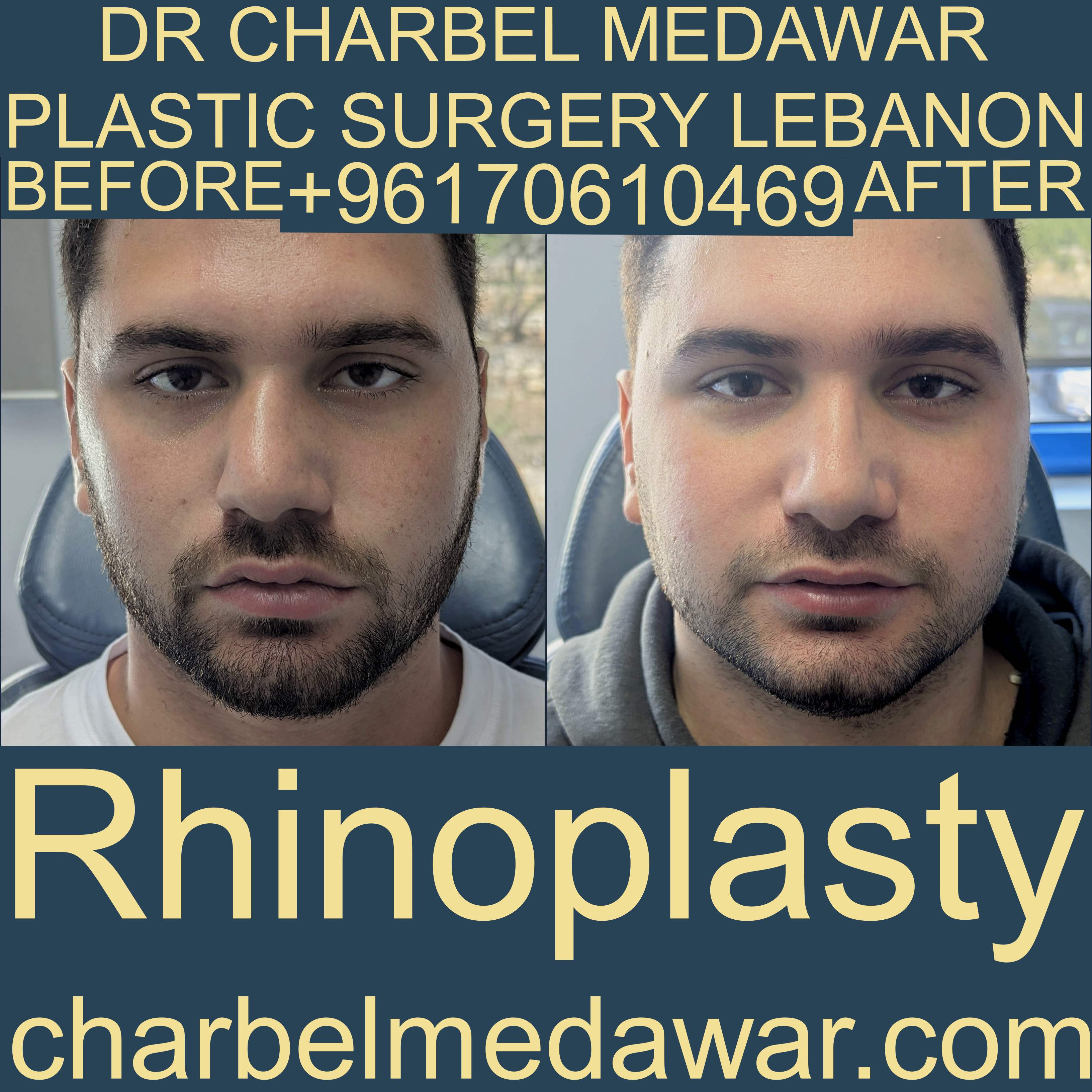 male rhinoplasty Lebanon