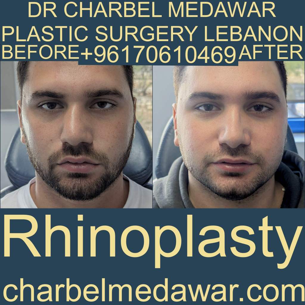 male rhinoplasty Lebanon