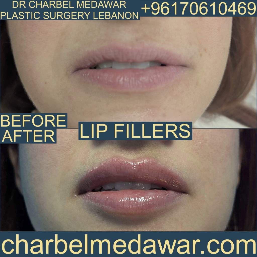 NEW LIP FILLER TECHNIQUE dr charbel medawar plastic surgery Lebanon