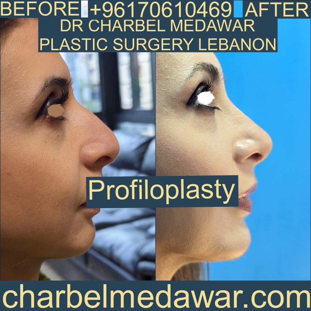 profiloplasty by dr charbel medawar plastic surgery lebanon