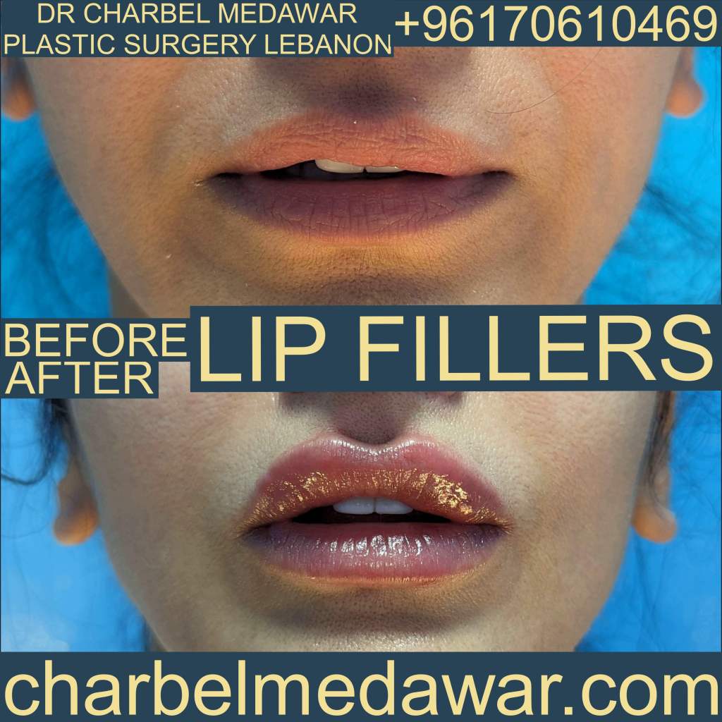 Russian lips charbel medawar plastic surgery Lebanon