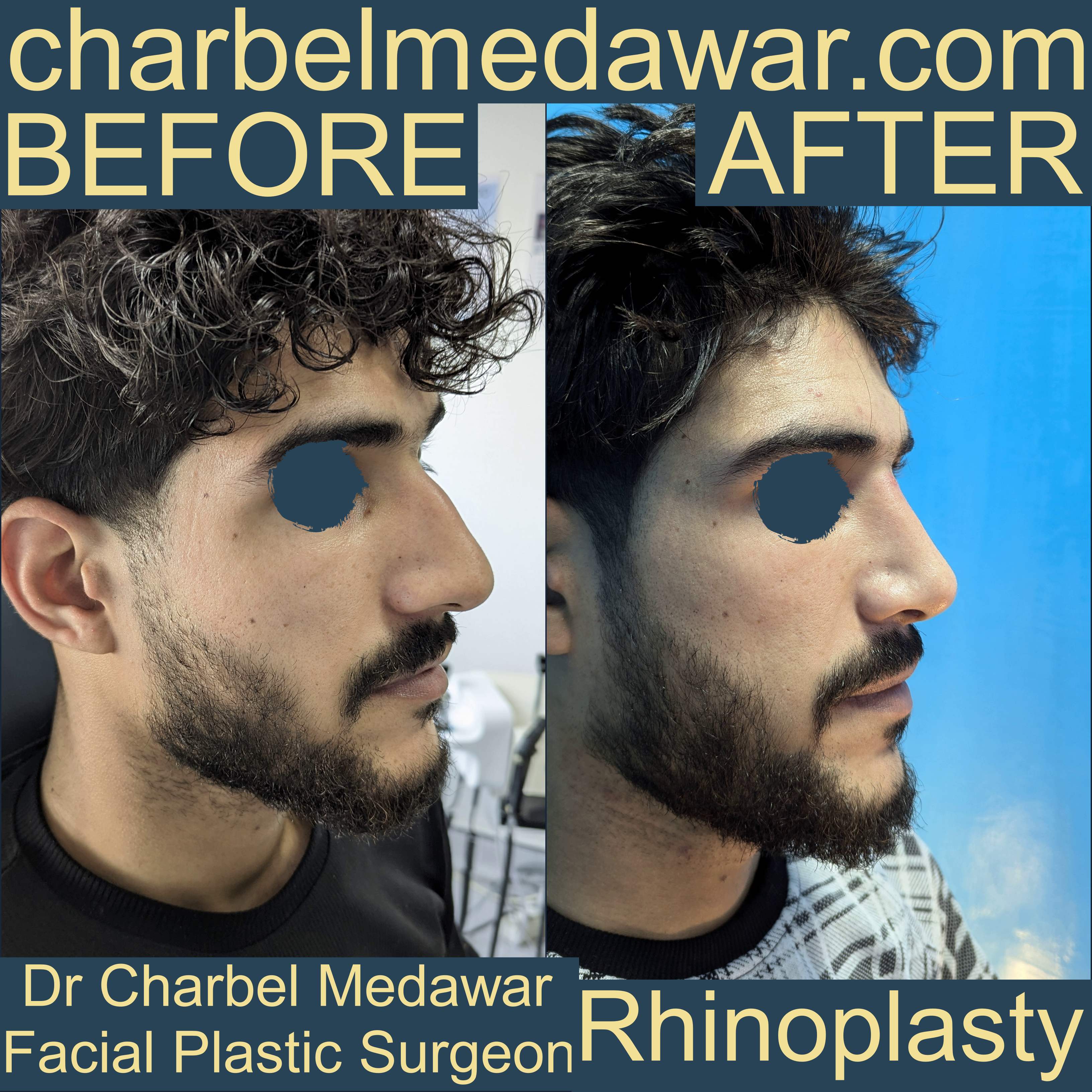 best nose job charbel medawar