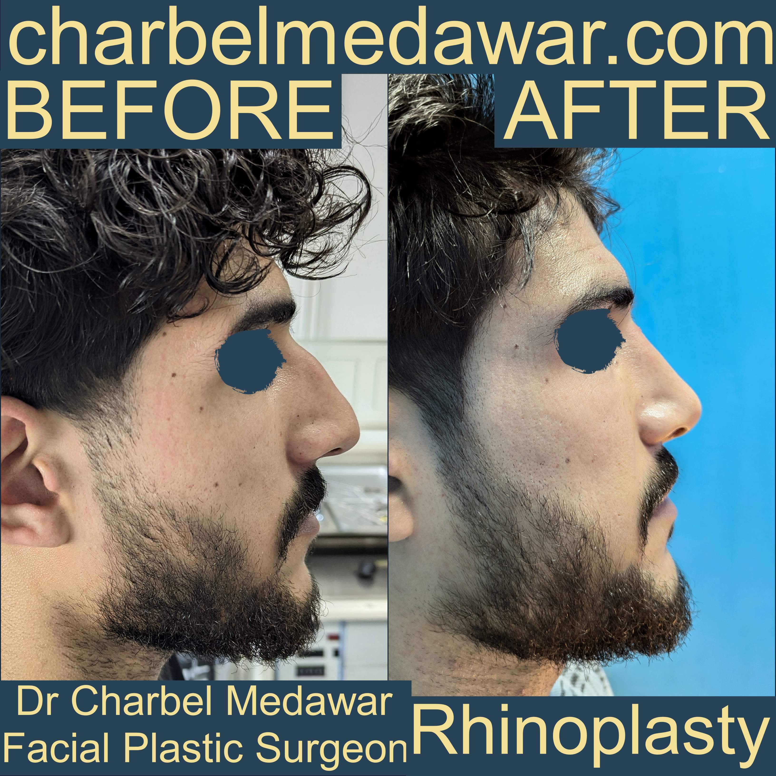 best nose surgery charbel medawar