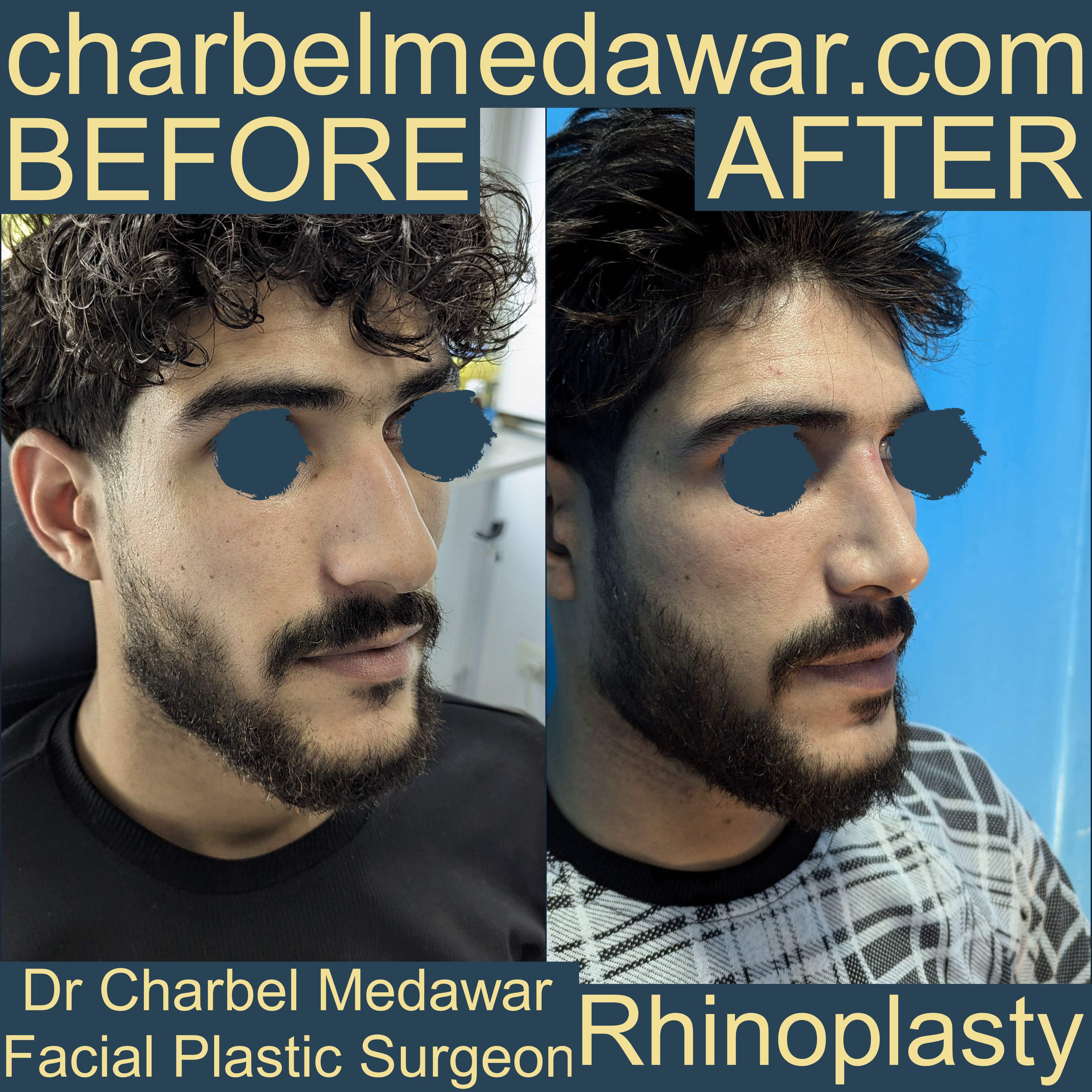 best rhinoplasty charbel medawar