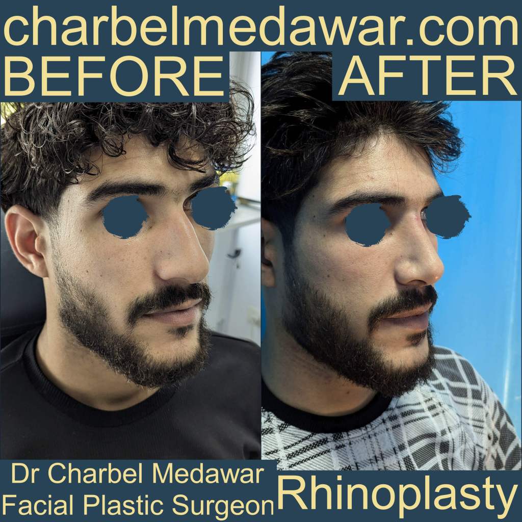 best rhinoplasty charbel medawar