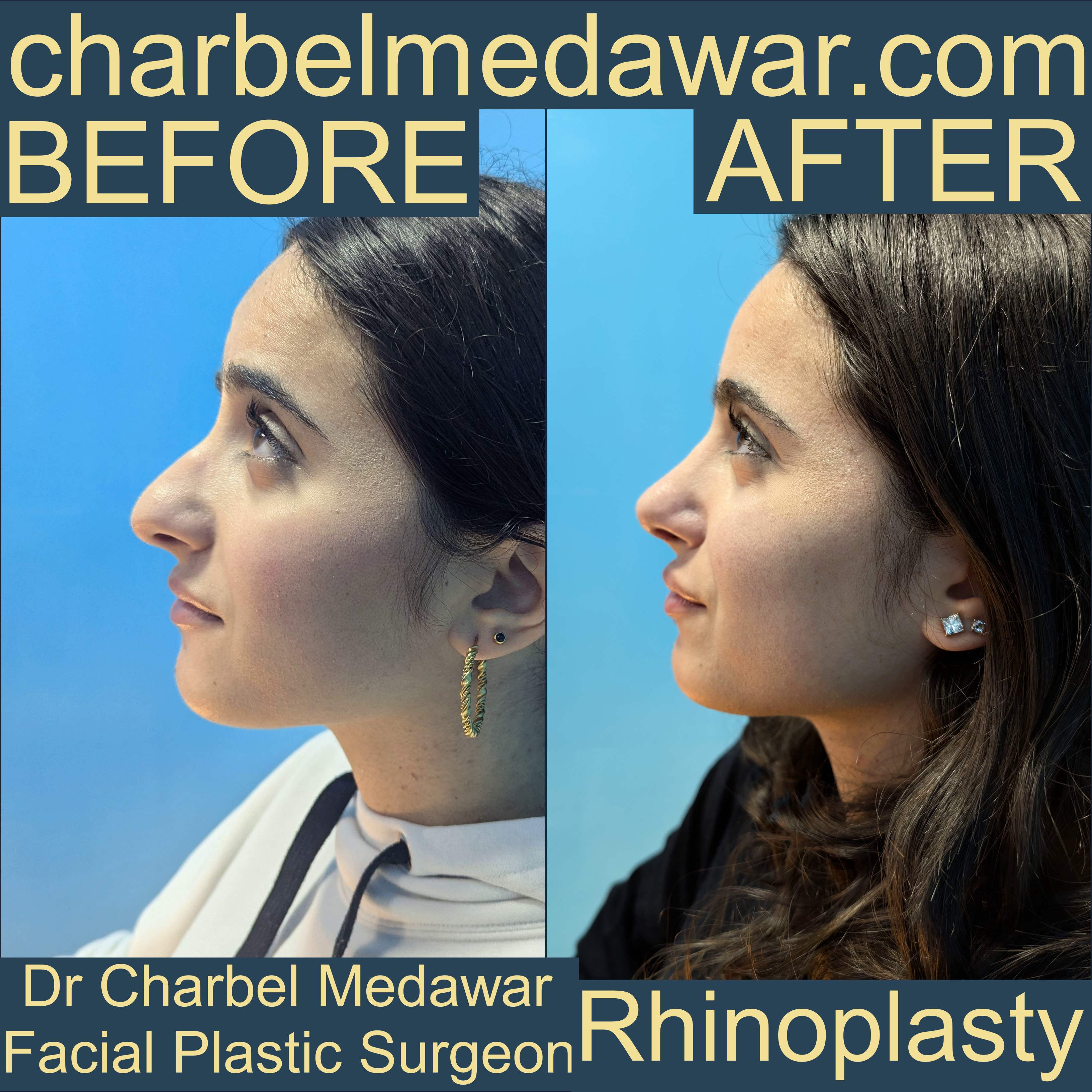 charbel medawar best nose doctor