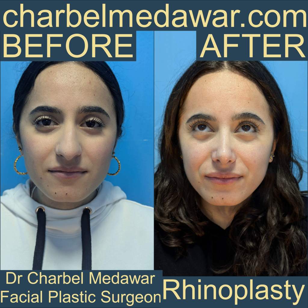 charbel medawar best nose surgeon