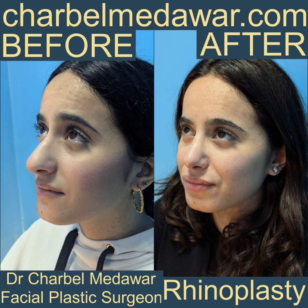 charbel medawar best rhinoplasty surgeon