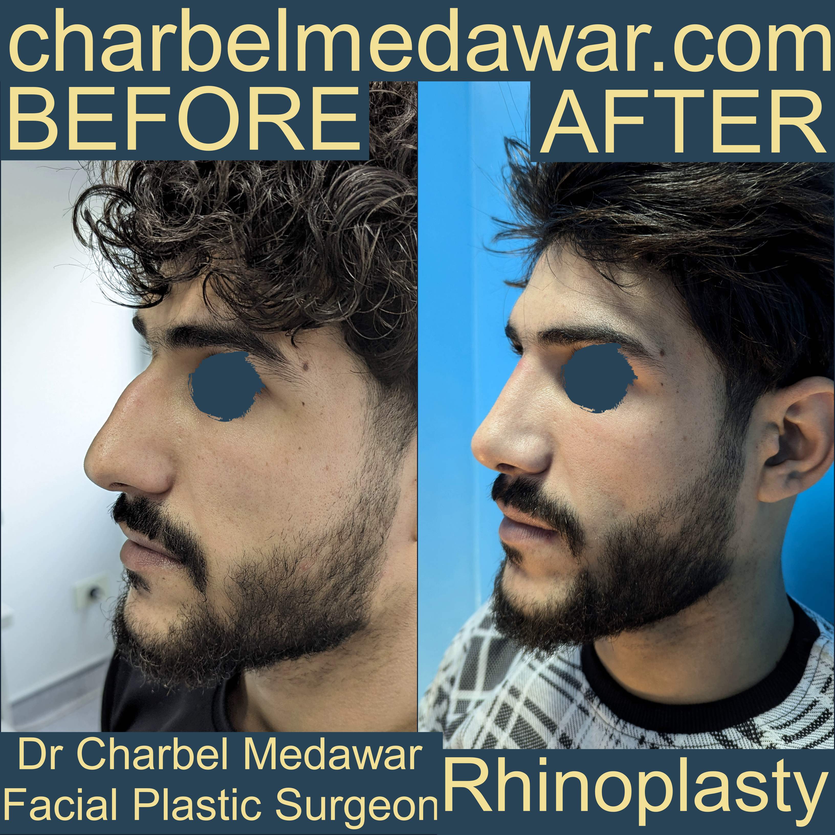 charbel medawar best rhinoplasty