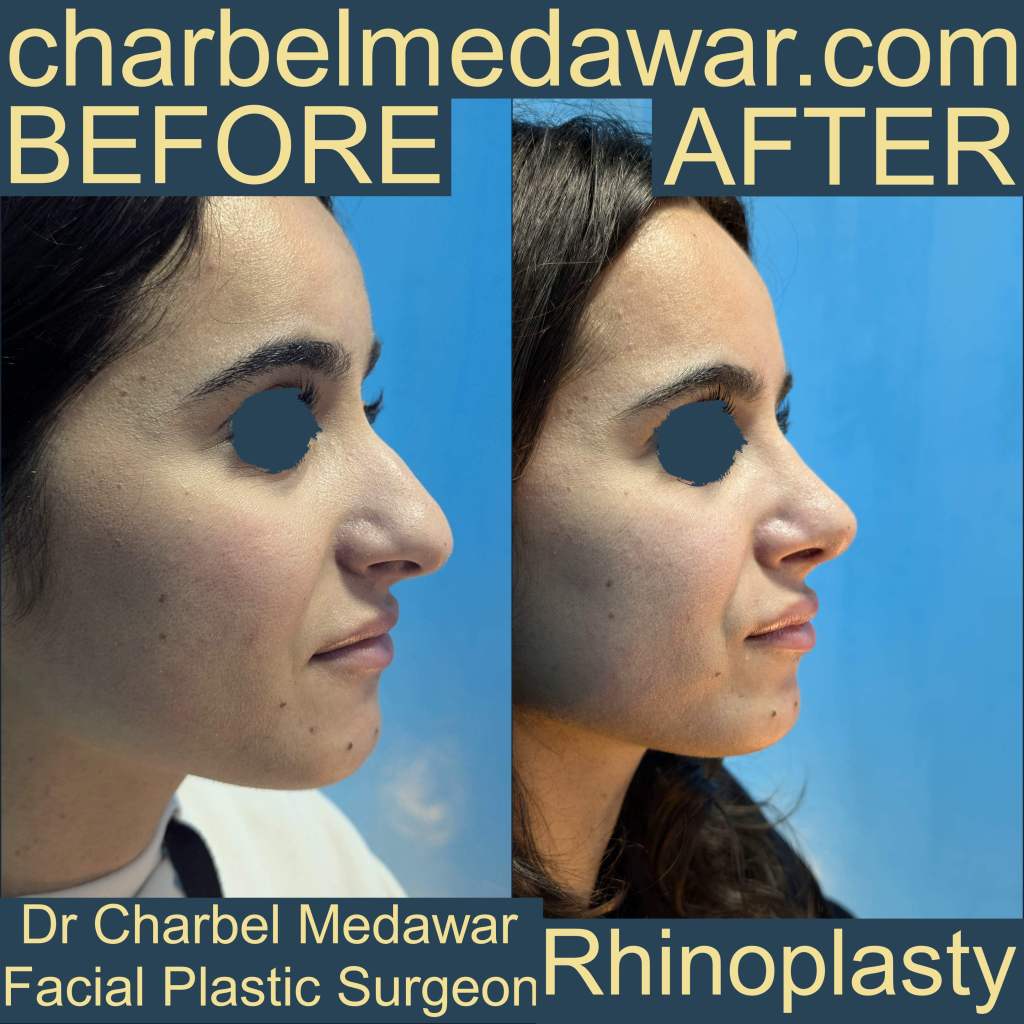 charbel medawar nose job specialist