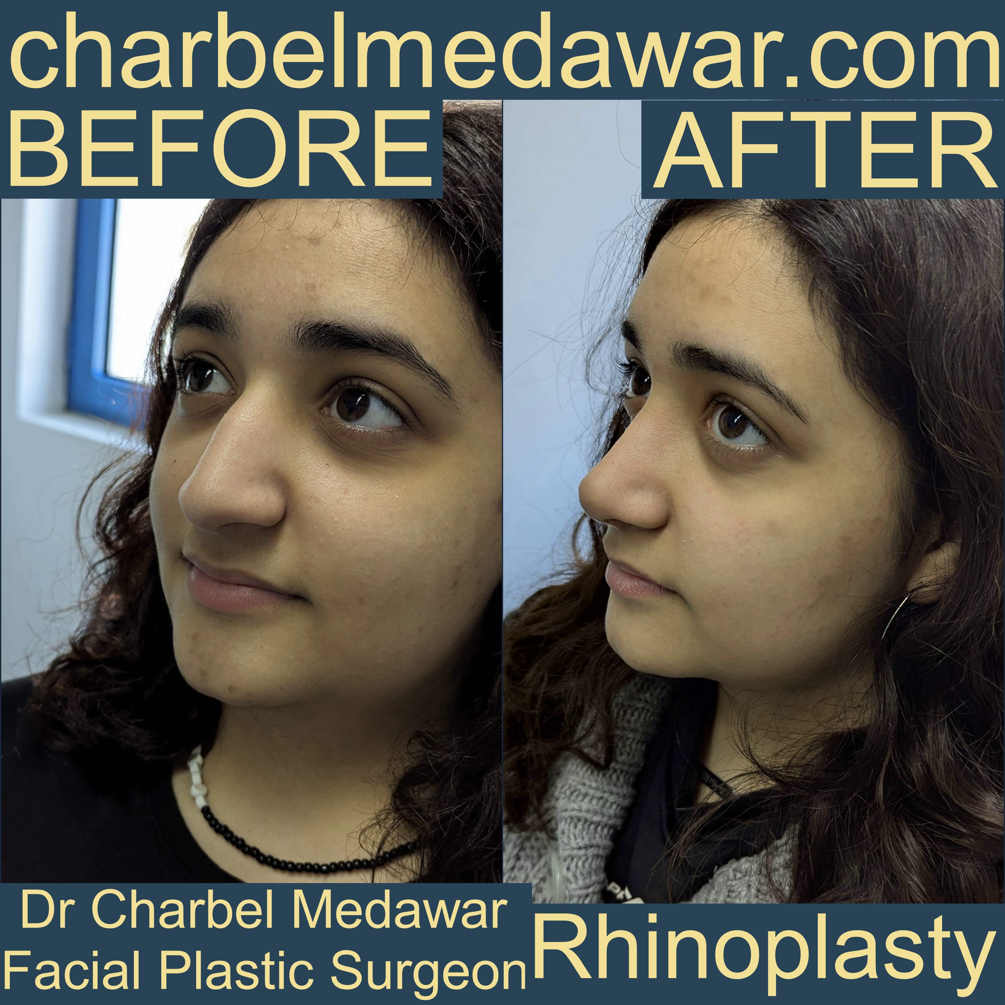 charbel medawar nose surgeon