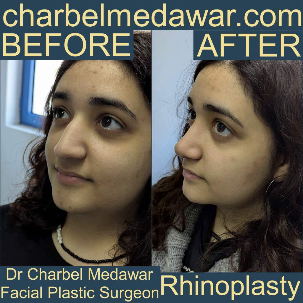 charbel medawar nose surgeon