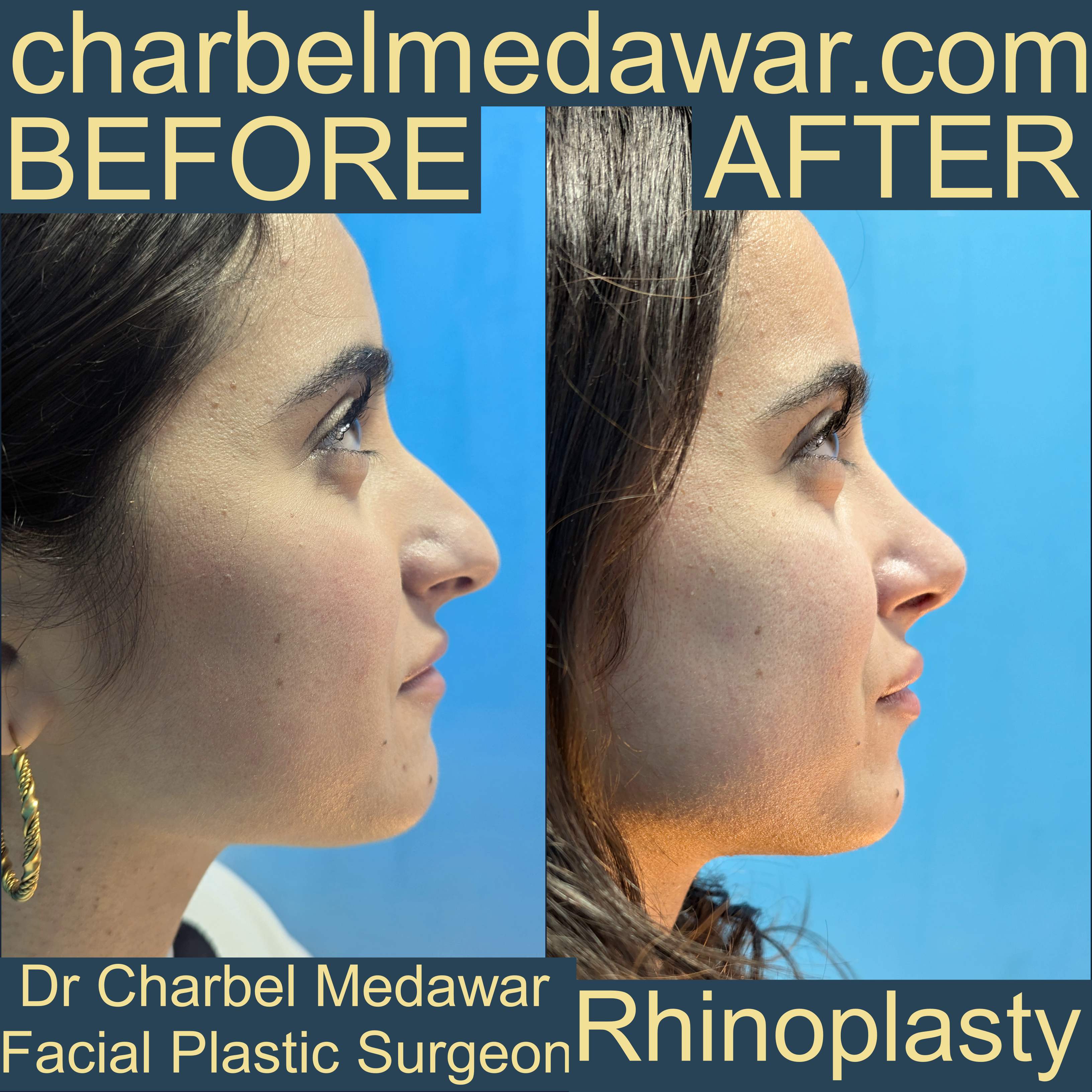 charbel medawar rhinoplasty specialist