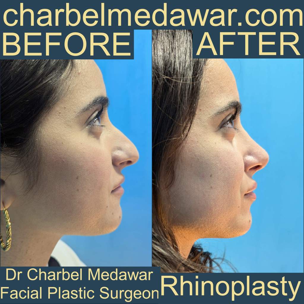 charbel medawar rhinoplasty specialist