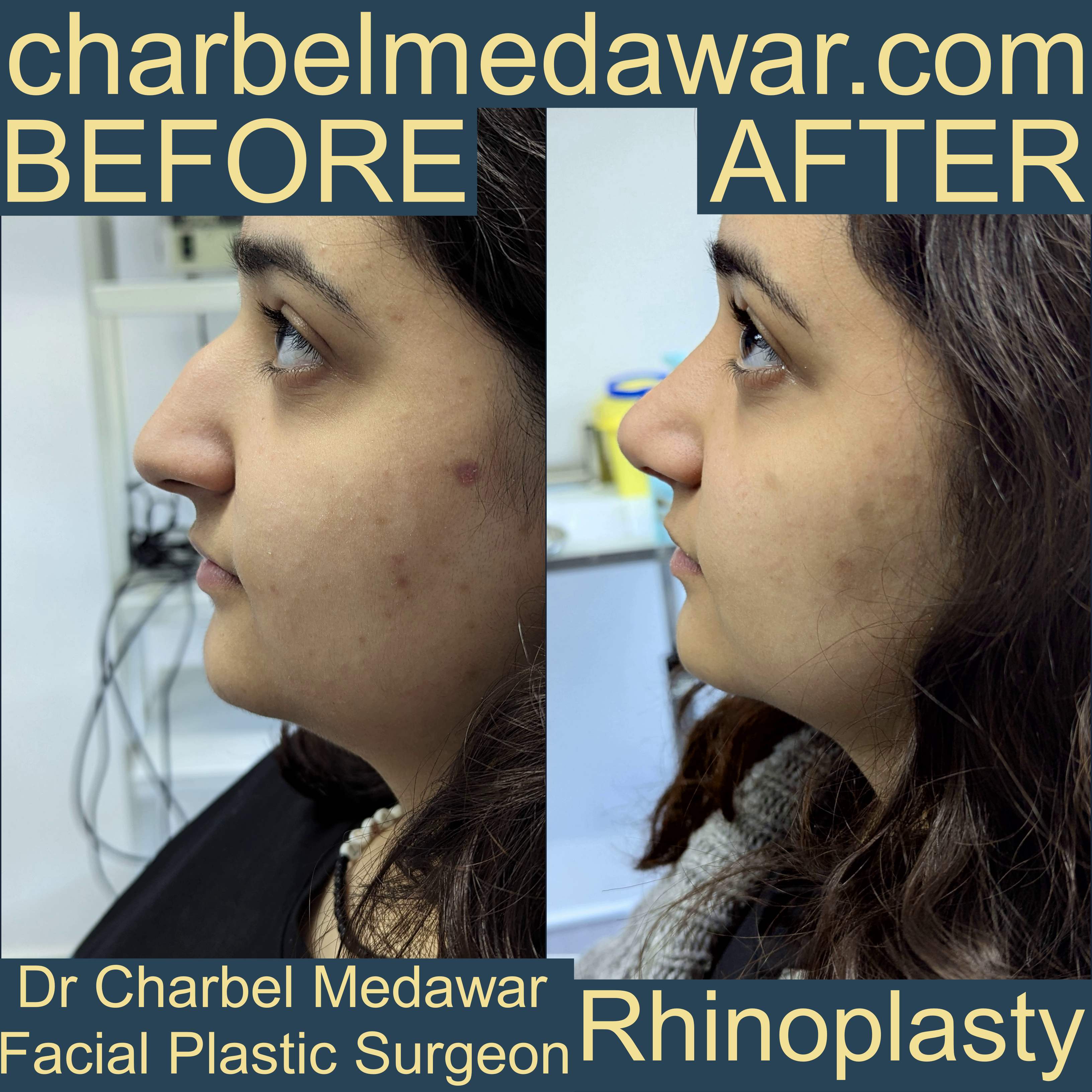 charbel medawar rhinoplasty expert