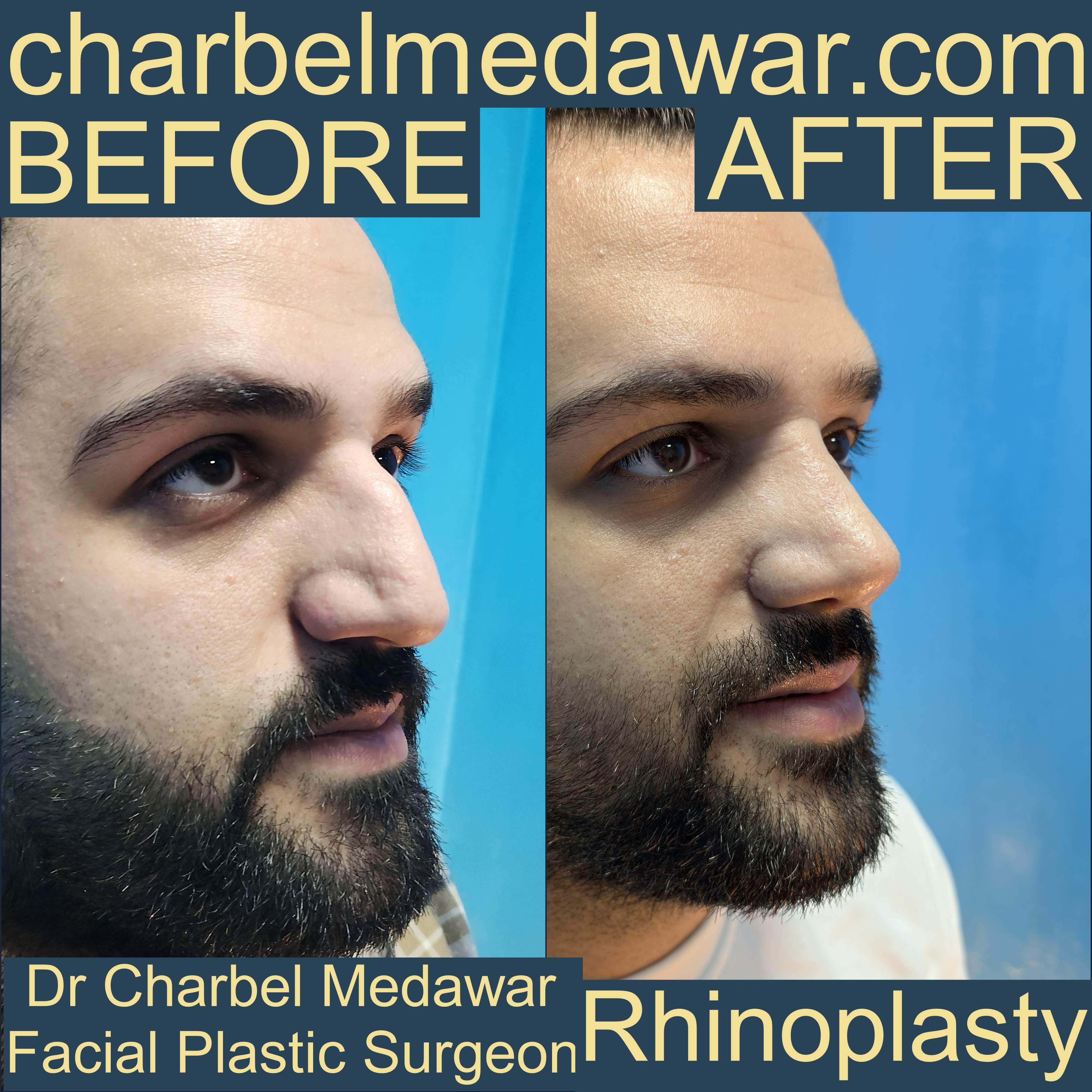doctor charbel medawar nose job expert