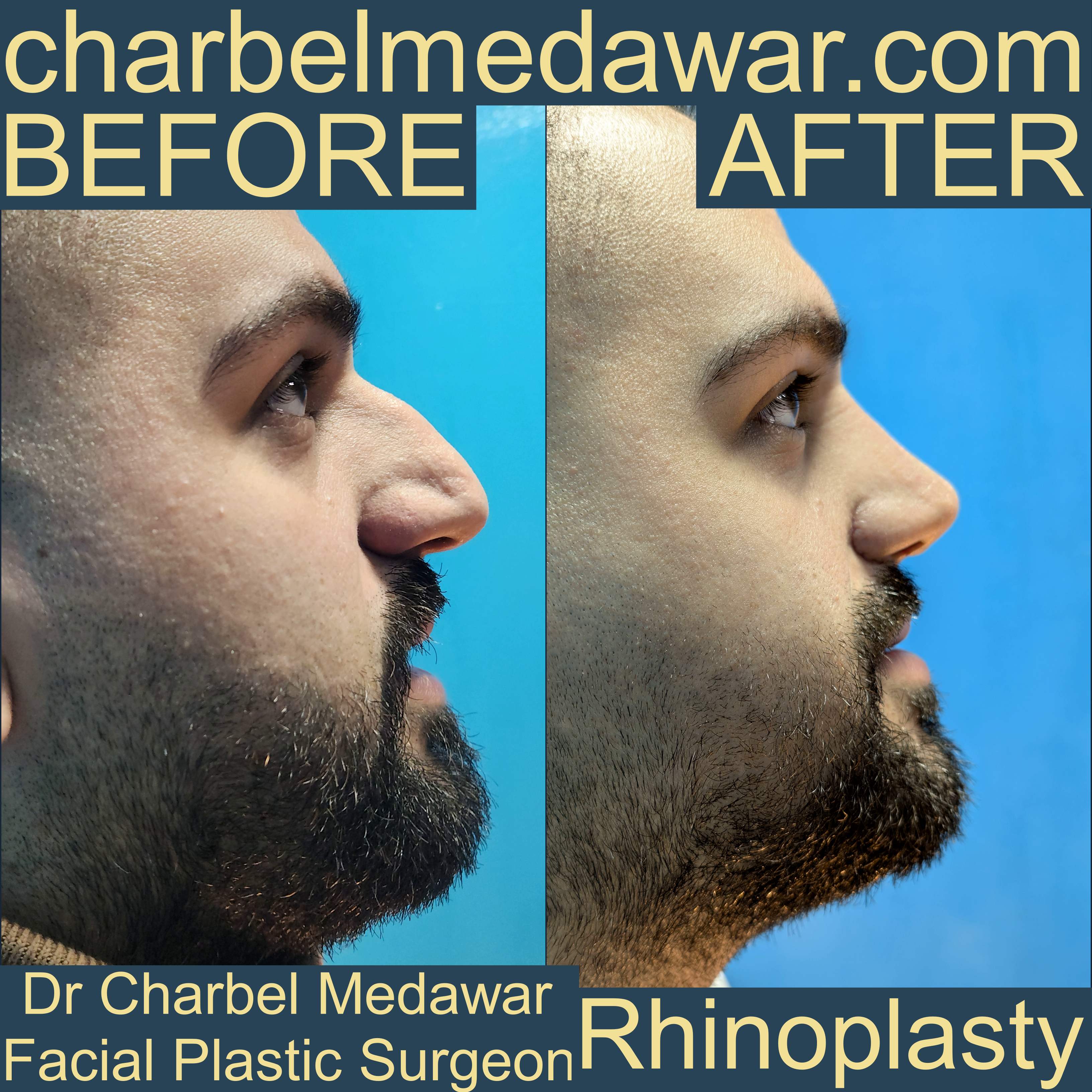 doctor charbel medawar nose job specialist