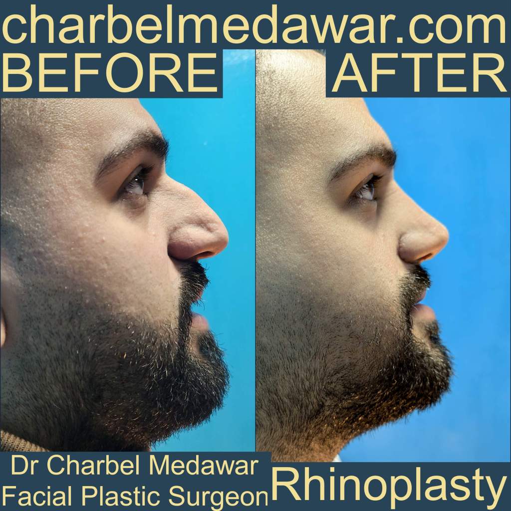 doctor charbel medawar nose job specialist