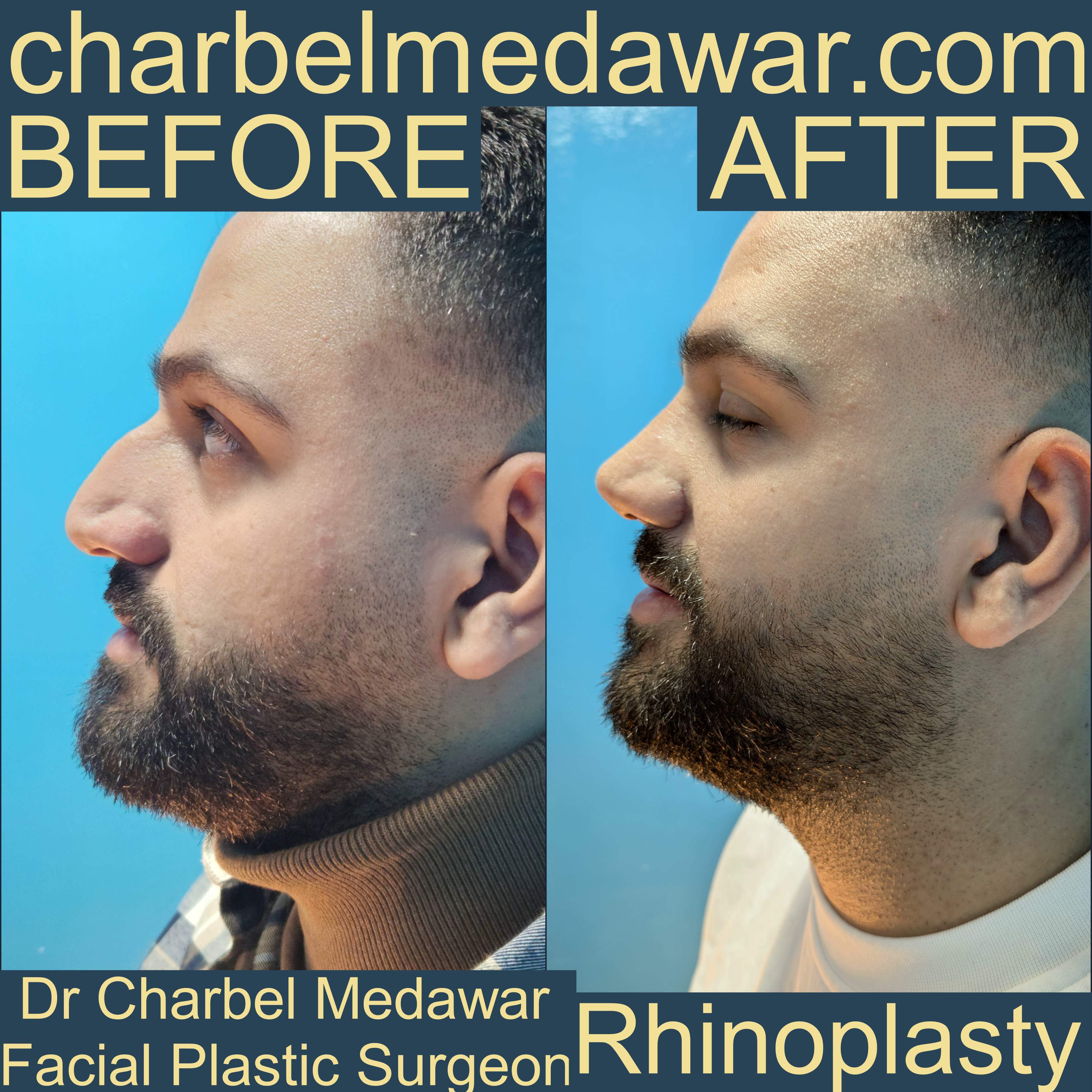 doctor charbel medawar rhinoplasty expert