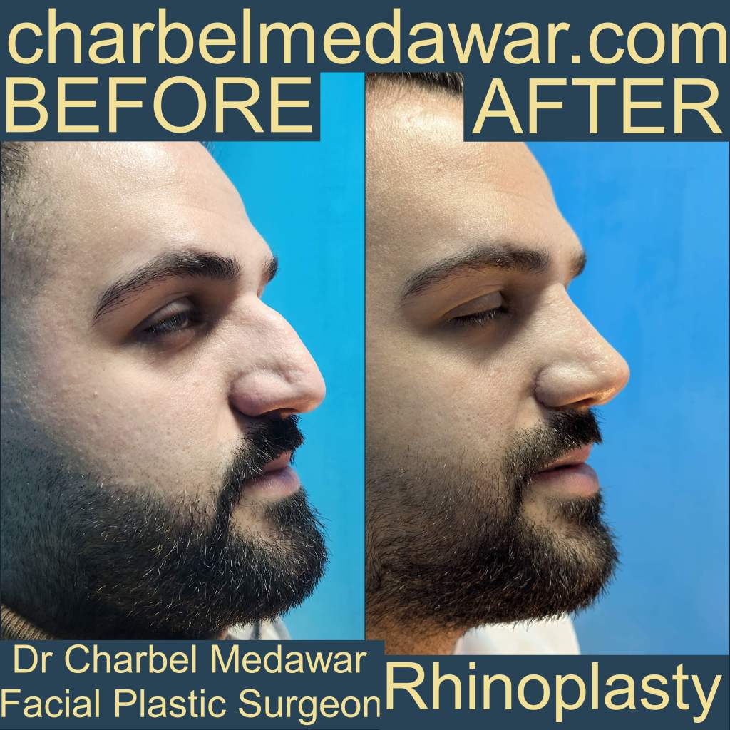 doctor charbel medawar rhinoplasty specialist