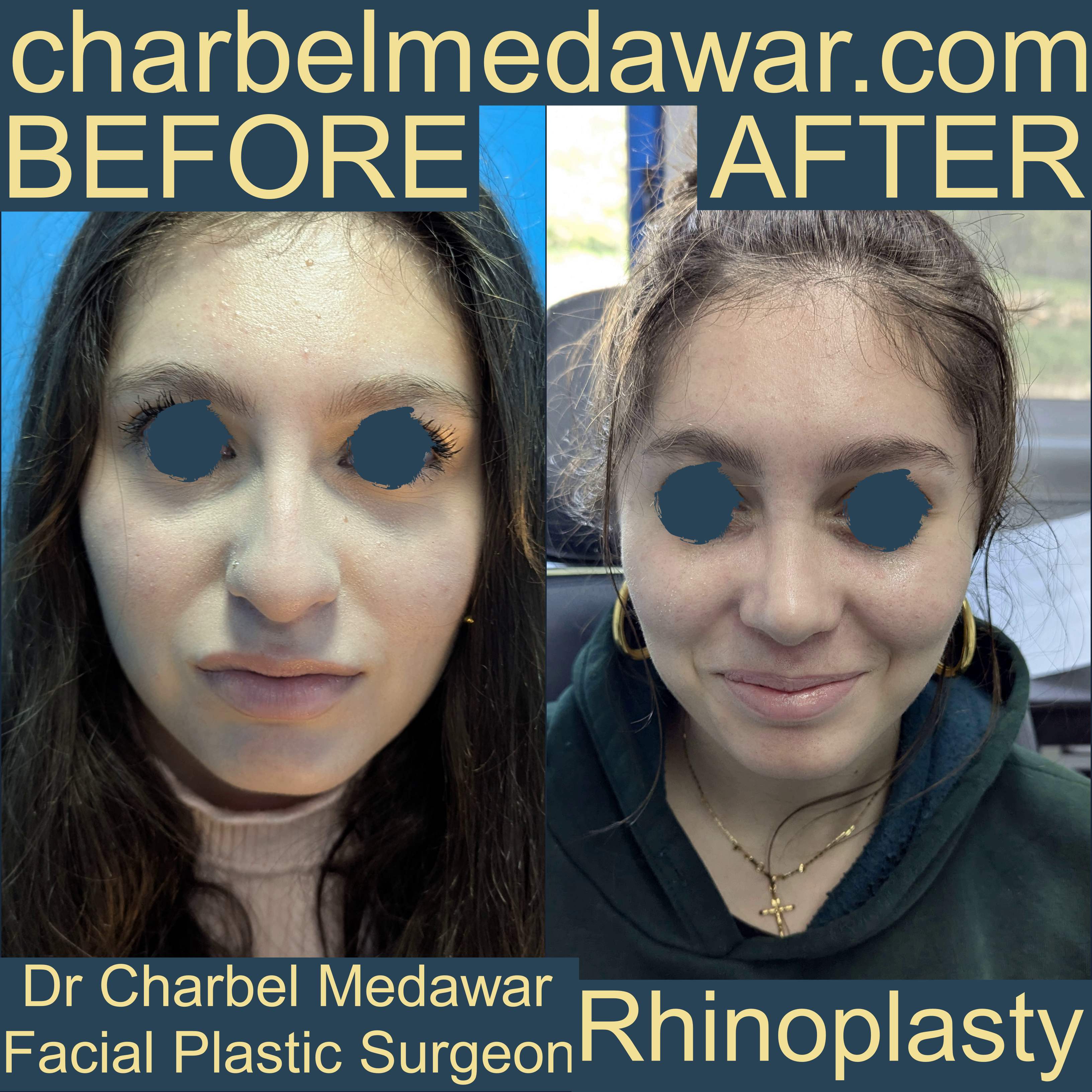 nose job expert charbel medawar