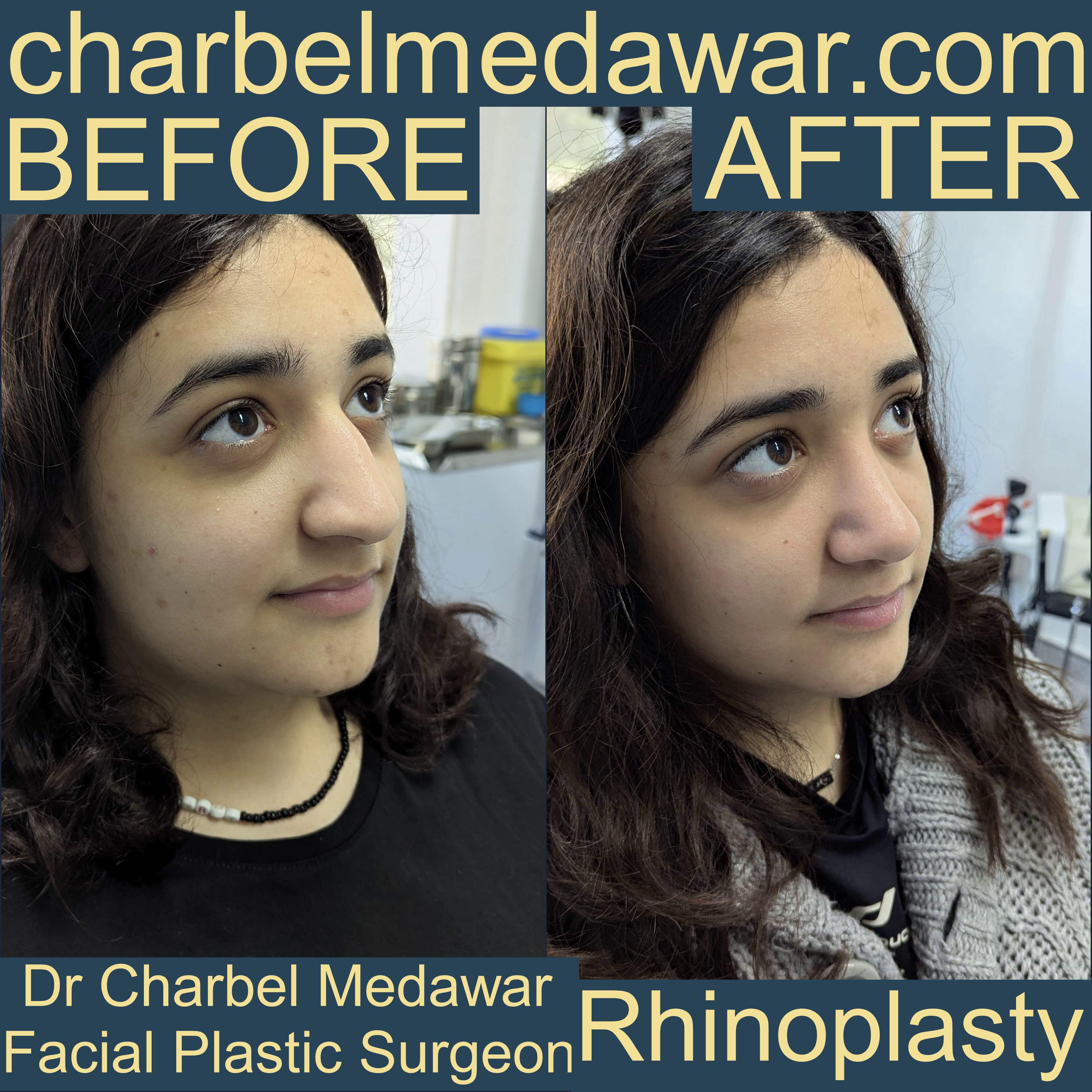 nose job expert doctor charbel medawar